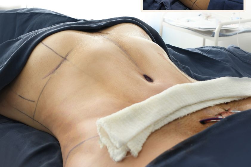 Abdominoplastia antes y después - 861396