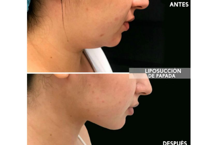 Liposucción antes y después - 626797