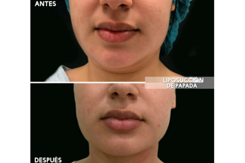 Liposucción antes y después - 626798