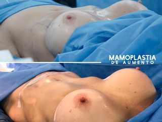 Mamoplastia de aumento