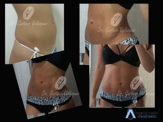 Marcacion abdominal