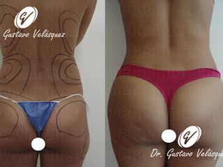 LASERLIPOLISIS DE CINTURA