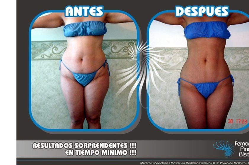 Tratamientos para adelgazar antes y después - 536843