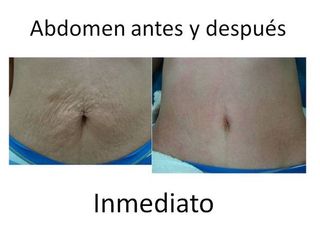 Abdomen Antes y después Inmediato.