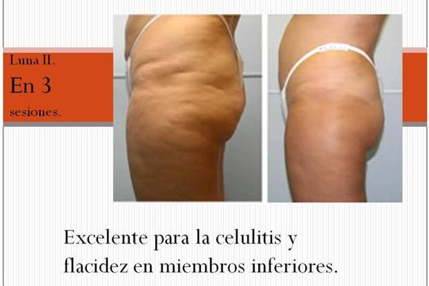 Celulitis antes y después - 537213