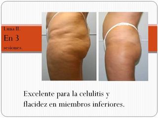 Tratamiento Contra Celulitis y Grasa Localizada