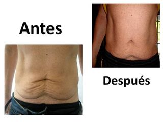 Flacidez eXtrema en abdomen, 1 sesión