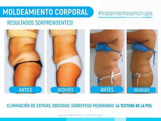 Moldeamiento Corporal Sin Cirugia