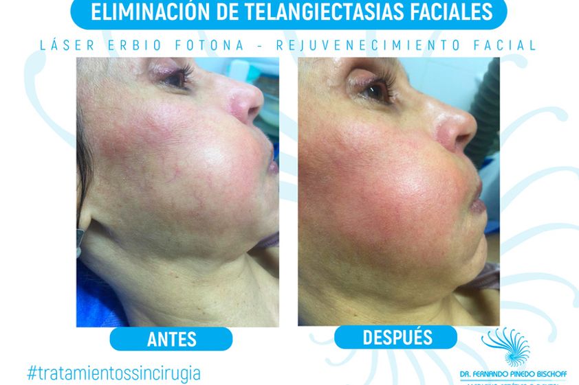 Várices antes y después - 638141