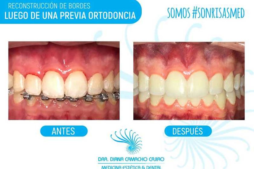 Ortodoncia antes y después - 640468