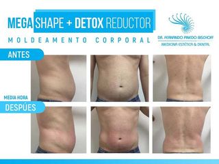 Moldeamiento Corporal Sin Cirugía con MegaShape + Detox Reductor