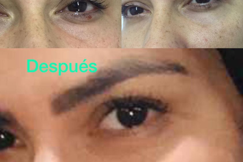 Rejuvenecimiento facial antes y después - 646723