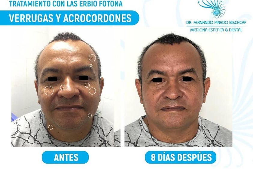 Verrugas antes y después - 647073