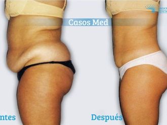 Tratamientos para adelgazar - 649292