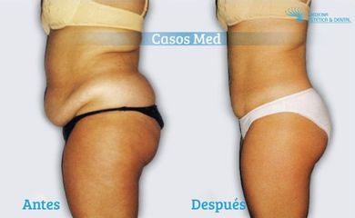 Moldeamiento Corporal SIN CIRUGIA