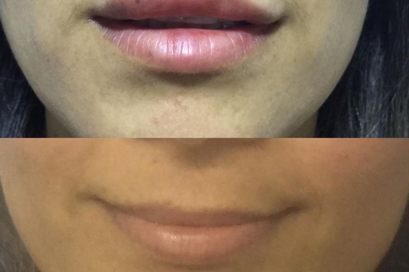 Aumento de labios antes y después - 662273