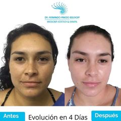 Rejuvenecimiento Facial con Láser de Erbio Fotona - Dr. Fernando Pinedo Bischoff