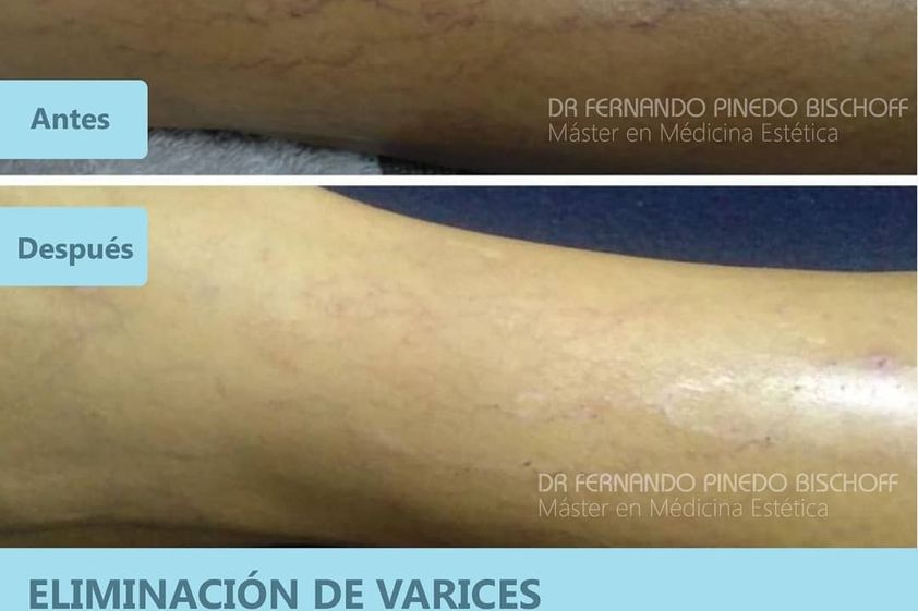 Várices antes y después - 693205