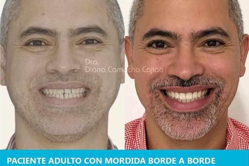 Ortodoncia antes y después - 693206
