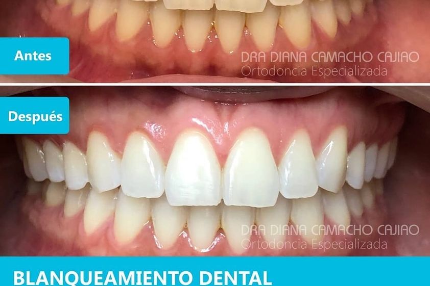 Blanqueamiento dental antes y después - 701330