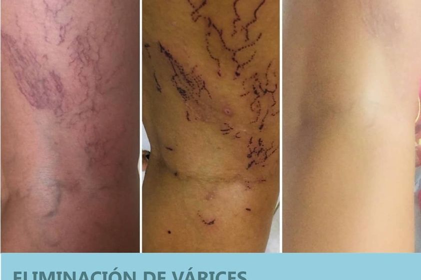 Várices antes y después - 701334