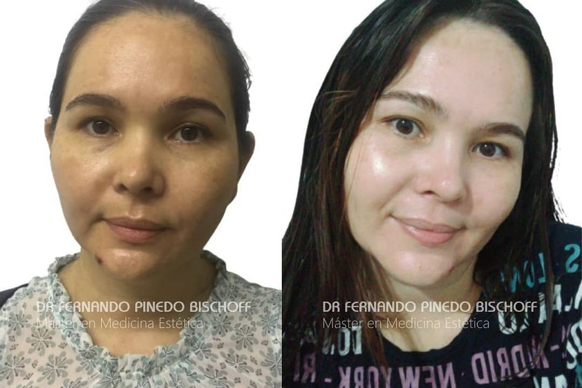Manchas en la piel antes y después - 737516
