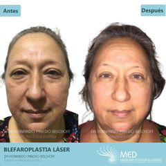 Blefaroplastia Laser (Sin Cirugia) - Dr. Fernando Pinedo Bischoff