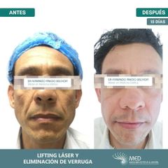 Lifting facial - Dr. Fernando Pinedo Bischoff