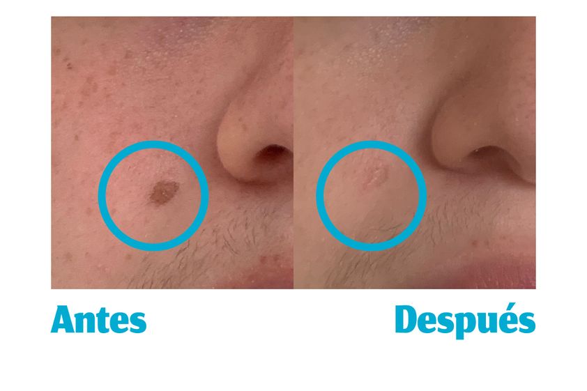 Verrugas antes y después - 856861