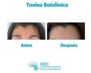 Toxina Botulínica - Dr. Fernando Pinedo Bischoff