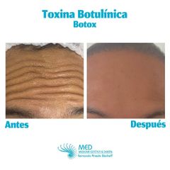 Toxina Botulinica - Dr. Fernando Pinedo Bischoff