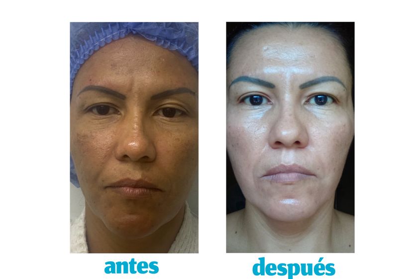 Manchas en la piel antes y después - 857614