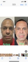 Rejuvenecimiento facial - Dr. Fernando Pinedo Bischoff