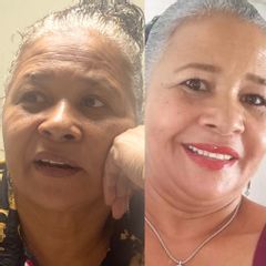 Rejuvenecimiento facial - Dr. Fernando Pinedo Bischoff