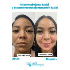 Rejuvenecimiento Facial y Tratamiento despigmentación facial - Dr. Fernando Pinedo Bischoff