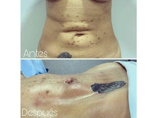 Lipoescultura Láser con Marcacion Abdominal HD - Dr. Erick Almenárez Mendoza