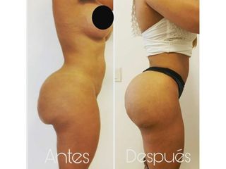 Gluteoplastia - Dr. Erick Almenárez Mendoza