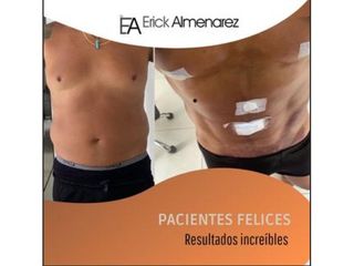 Abdominoplastia - Dr. Erick Almenárez Mendoza