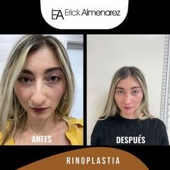 Rinoplastia - Dr. Erick Almenárez Mendoza