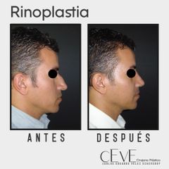 Rinoplastia - Dr. Carlos Eduardo Vélez
