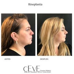 Rinoplastia - Dr. Carlos Eduardo Vélez