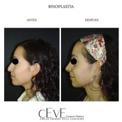 Rinoplastia - Dr. Carlos Eduardo Vélez