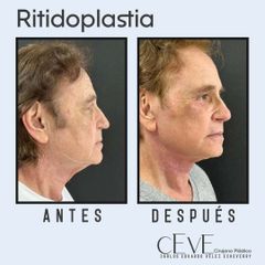 Armonización facial - Dr. Carlos Eduardo Vélez