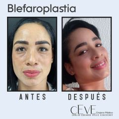 Blefaroplastia - Dr. Carlos Eduardo Vélez