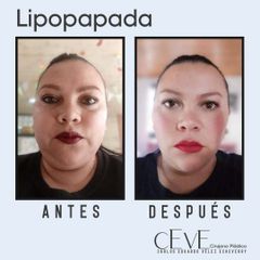 Lipopapada - Dr. Carlos Eduardo Vélez