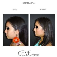 Rinoplastia - Dr. Carlos Eduardo Vélez