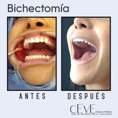 Bichectomía - Dr. Carlos Eduardo Vélez