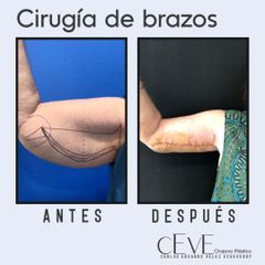 Cirugia de Brazos -Dr. Carlos Eduardo Vélez