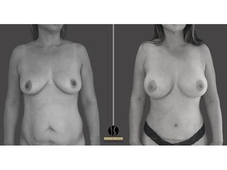 abdominoplastia, lipoescultura, mamoplastia de aumento