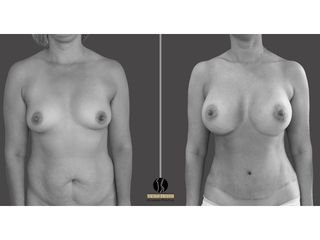 abdominoplastia, lipoescultura, mamoplastia de aumento